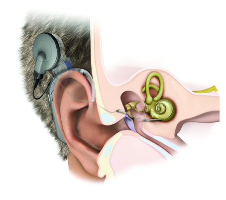 Ốc tai điện tử là phương pháp Cấy ghép một hệ thống phức tạp vào bên trong tai