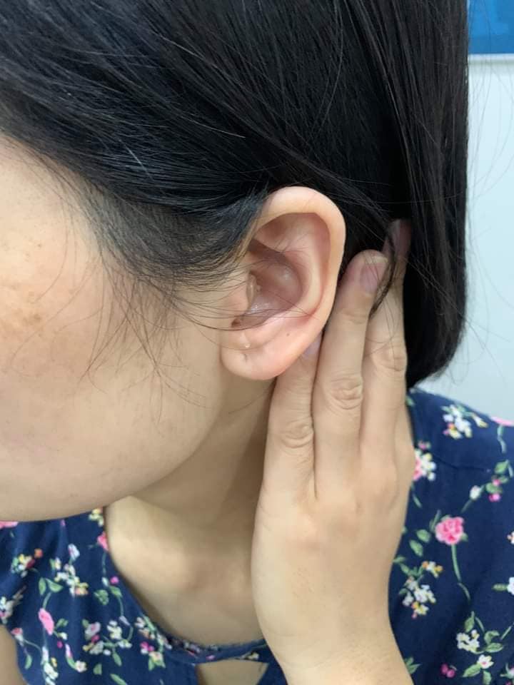 Hình ảnh khách hàng đeo máy trợ thính trong tai IIC