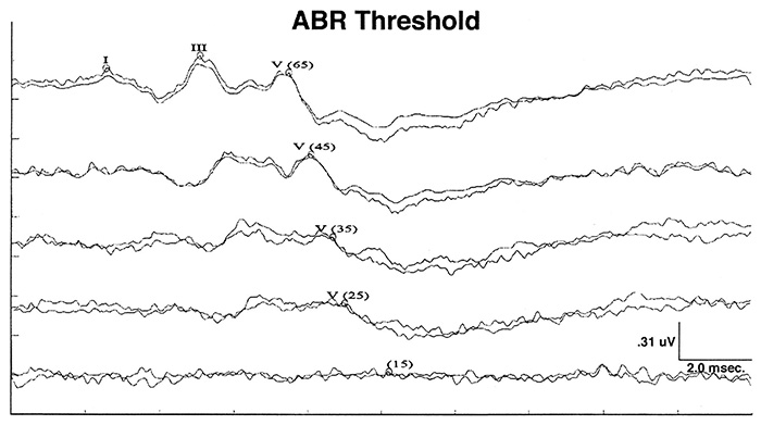 Phương pháp đo ABR