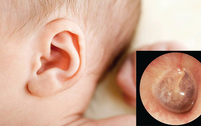 Bệnh viêm tai giữa ở trẻ