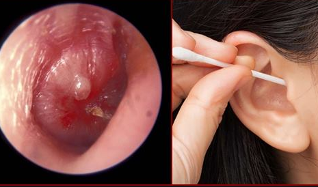 Dùng tăm bông hoặc các dụng cụ kim loại có thể làm nhiễm trùng tai hoặc thủng màng nhĩ